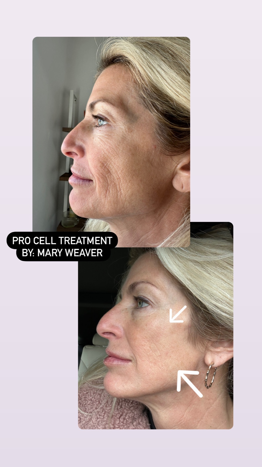 Procell Microchanneling treatment